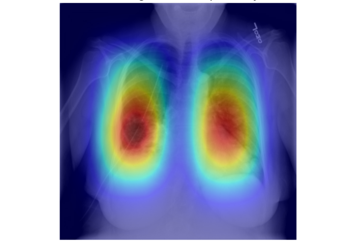 Pneumonia Detection & Localization System
